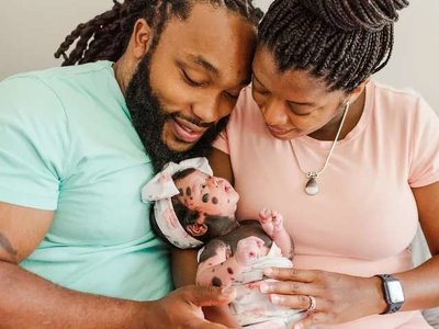 Батьки були налякані, коли побачили свою дитину: як сьогодні виглядає дівчинка-панда