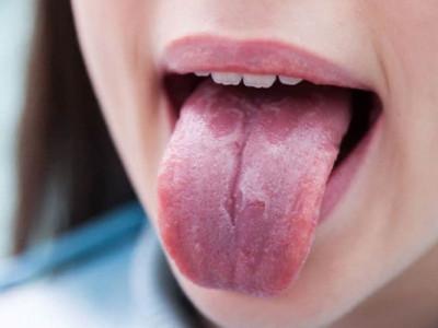 Симптом на язику, який свідчить про нестачу заліза
