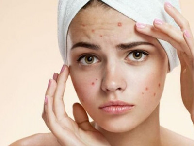 Чому прищі з'являються саме тут? Приховані сигнали організму, які можуть шокувати!