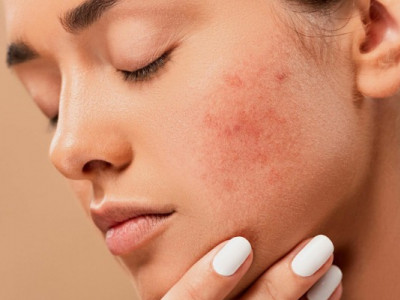 Лікар-дерматолог: прищі на різних ділянках обличчя можуть вказувати на різні хвороби