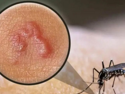 Мігрував під шкірою: з живота чоловіка дістали паразита довжиною 1,9 см