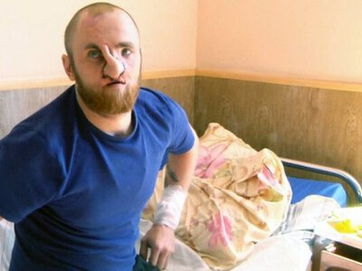 «І дихати можу, і запахи відчуваю»: хірурги відновлюють обличчя воїну