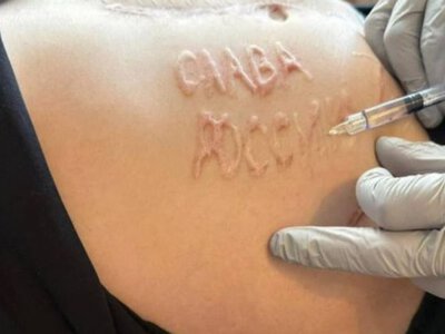 Це зробив хірург — медик про напис слава россии на тілі звільненого з полону воїна