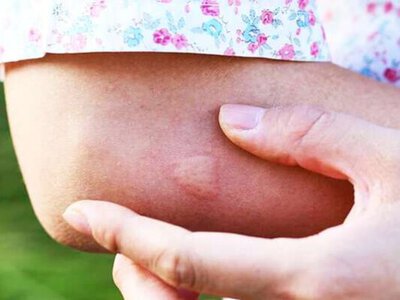 Величезного паразита витягли з-під шкіри жінки на заході України: жахливі наслідки укусу комара