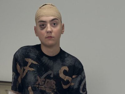 Львівські лікарі успішно видалили рідкісну пухлину з головного мозку 17-річного хлопця