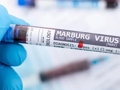 У Ефіопії підтверджено спалах хвороби, спричиненої вірусом Марбурга