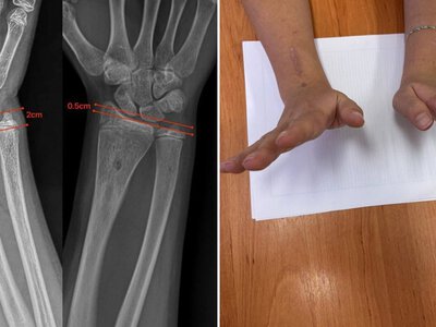 Закарпатські медики вилікували складну деформацію передпліччя у 12-річної пацієнтки