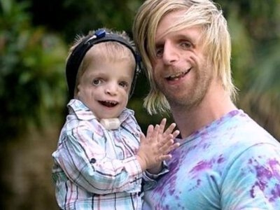 Незвичайна історія незвичайного хлопця: яка хвороба у Джоно Ланкастера?