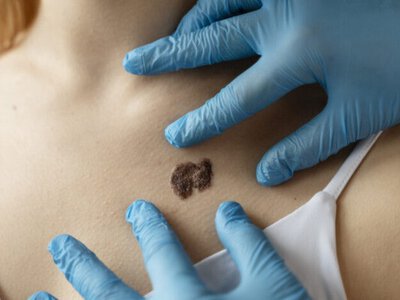 Лікарі дали поради для лікування бородавок