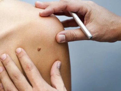 Рак шкіри: базальноклітинна та плоскоклітинна карцинома.