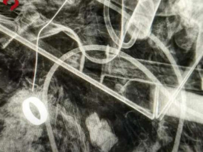 Медики знайшли обручку пораненого військового за допомогою рентгену