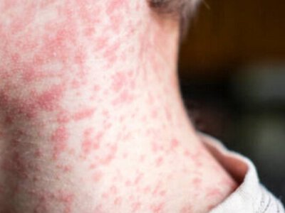 Великобританія та низка інших держав втратили статус країн, що ліквідували кір