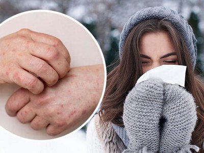 Чому взимку з'являється нежить і висип: що приховує зимова алергія та як її розпізнати