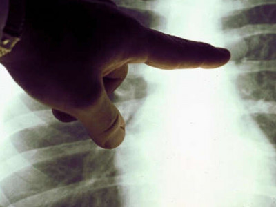 ВООЗ назвала топ-5 факторів ризику для появи онкології