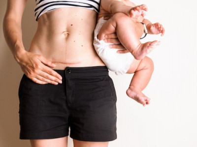 Відновлення після кесаревого розтину: шви, менструація, навантаження, самопочуття