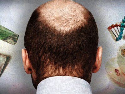 Медики назвали фактор, який прискорює облисіння