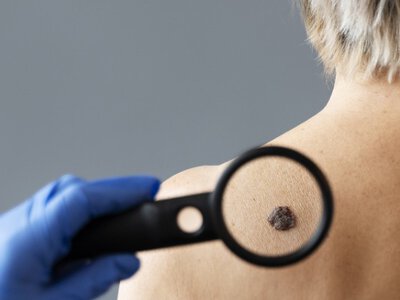 Коли родимка стає небезпечною: 5 критичних ознак, які не можна ігнорувати