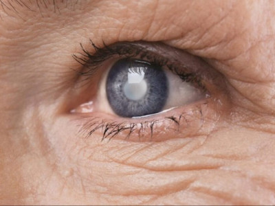 Катаракта не вирок: її лікують безкоштовно за державною програмою