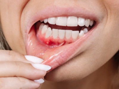 Біль у яснах може вказувати на серйозні проблеми: що робити?