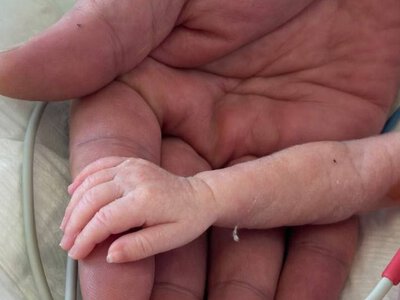 Українські лікарі врятували дитину, яка народилася з вагою менше, ніж кілограм