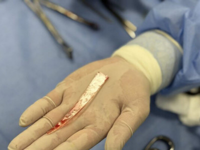 Львів’янину витягли із легені 10-сантиметровий уламок скла після атаки дронів