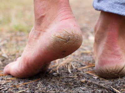 Ви це ігноруєте — а дарма: чому тріскаються п'яти і як це зупинити