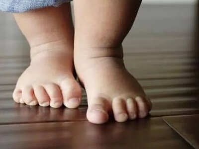 Диво у Кривому Розі: лікарі врятували ніжку 9-місячній дівчинці, яка постраждала від дрону рф