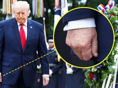 79-річний Трамп приховує синці та занадто часто відвідує лікарів: що з його здоров'ям