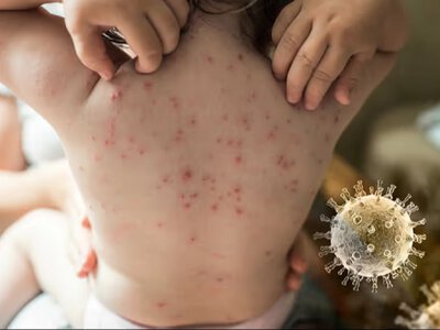 На Дніпропетровщині поменшало хворих на ГРВІ, але медики фіксують підозри на кір і краснуху