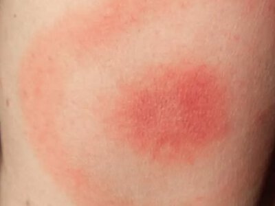 У Шептицькому зафіксували вісім випадків хвороби Лайма