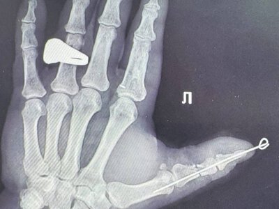 У Чернівцях медики вперше врятували повністю відрізаний палець руки
