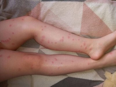 Свербіж після купання у Світязі: у нацпарку пояснили, чому висип не є небезпечним