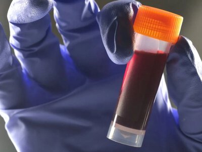 Генетична пастка: вчені з’ясували, яка група крові підвищує ризик розвитку діабету