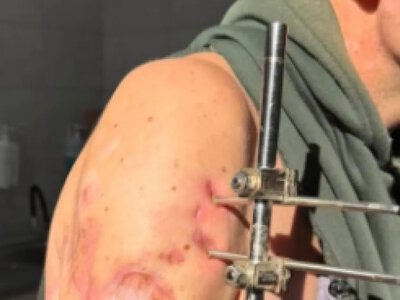 В Одесі лікарі врятували руку пораненому військовому після надскладної операції