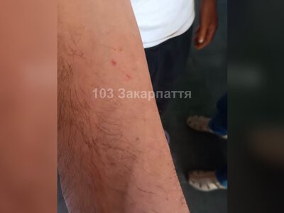 На Тячівщині 40-річного чоловіка госпіталізували з підозрою на укус змії