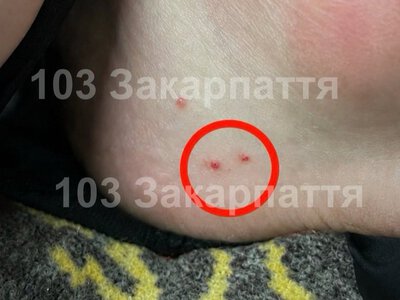  У Тячівському районі чоловіка госпіталізували після укусу отруйної змії 