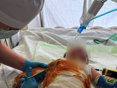 У Чернівцях лікарі врятували дитину з тяжкими опіками, яку доправили у критичному стані