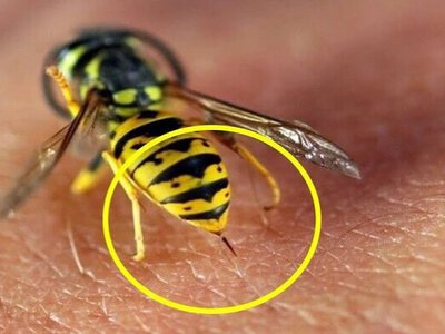 Більшість робить це неправильно: як діяти після укусу комахи