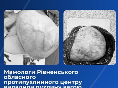 У Рівному медики видалили пацієнтці гігантську пухлину молочної залози вагою понад 5,5 кілограма