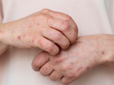 Жителі області хворіли на вітряну віспу і скарлатину