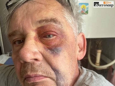 11 переломів черепа, а у справі — свідок: родина з Радомишля вимагає розслідування ДТП