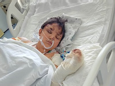 Понад місяць боролася за життя: у лікарні померла 12-річна Саша із Сумщини, яка отримала опіки унаслідок атаки безпілотника