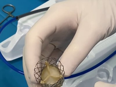 Без розтину грудної клітки: у Черкасах 75-річній пацієнтці замінили аортальний клапан