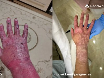 Лікування рубців та шрамів безоплатно: Волинь долучилася до програми «Неопалимі»
