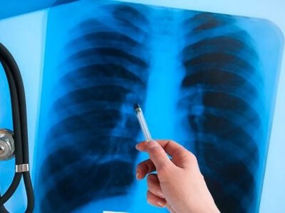 У громадах Рівненщини цього місяця проводитимуть безкоштовне тестування на туберкульоз