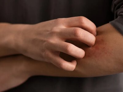 У Європі зафіксували третій випадок небезпечної лихоманки