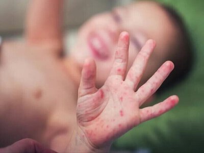 Спалах кору: яка ситуація в Україні