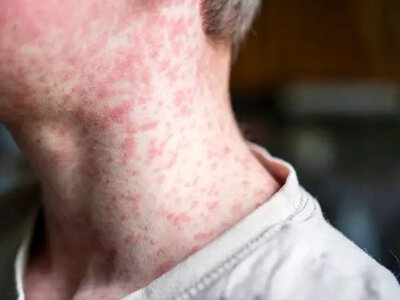 Чотири випадки кору зафіксували на Черкащині від початку року