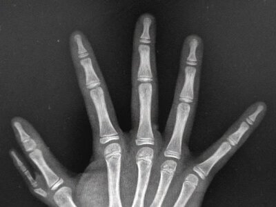 У Вінниці 9-річній дівчинці видалили додатковий палець: хірурги провели складну операцію