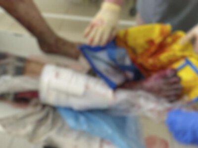 Двоє мешканців Прудянки підірвалися на вибуховому пристрої на в’їзді до села